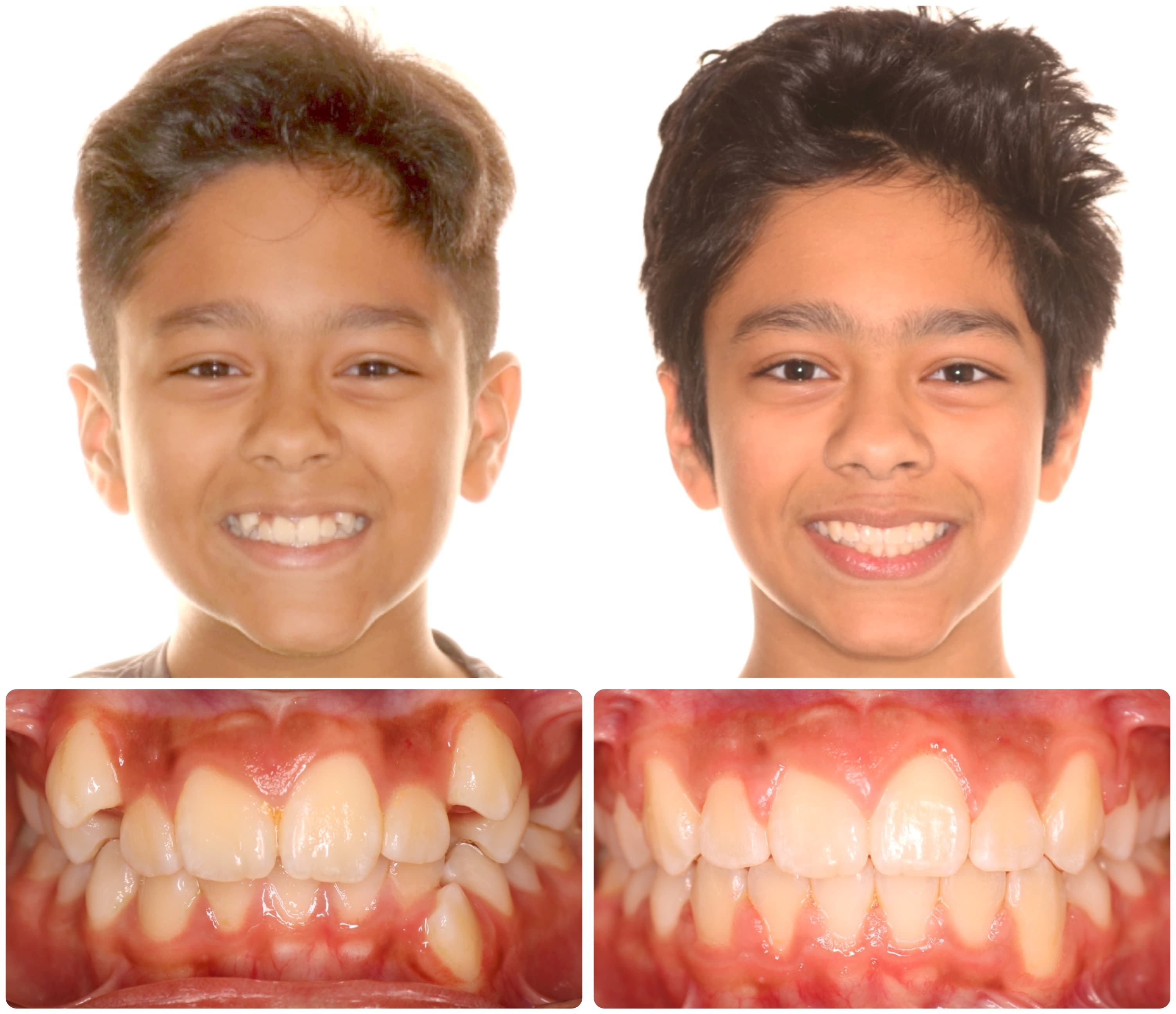 Before and after braces treatment results - facial and dental views