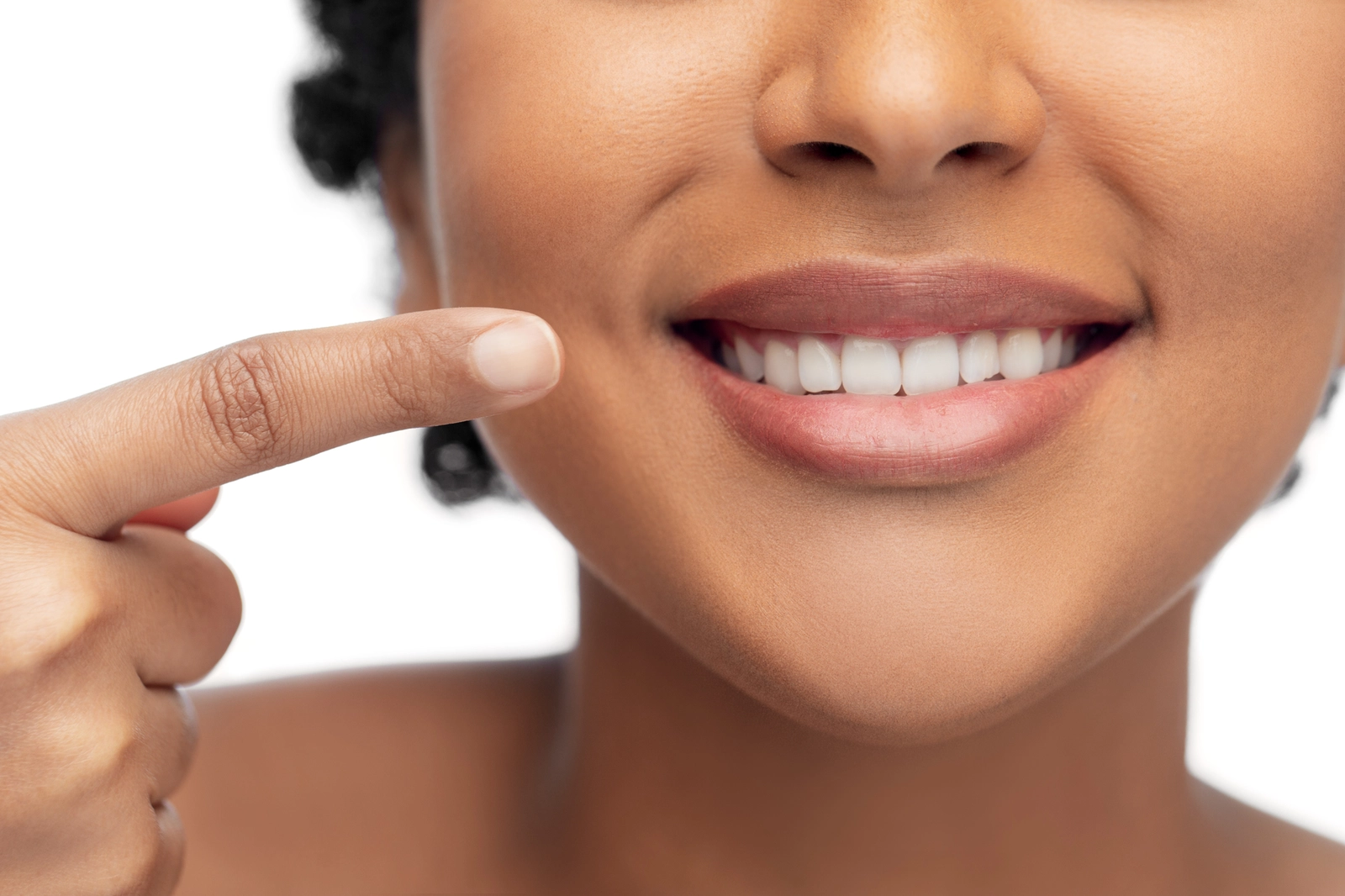 What Are Dental Veneers?